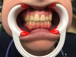 Teeth Whitening - Before